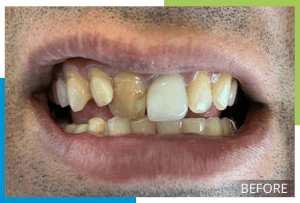 Smile-Makeovers-Before