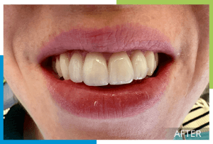 Veneers-1-After