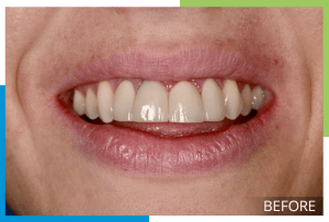 Veneers-1-Before