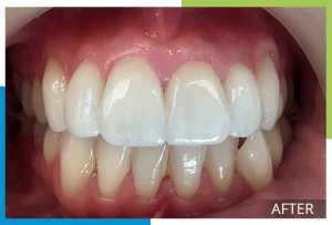 Veneers-2-After