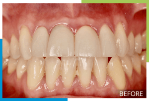 Veneers-2-Before