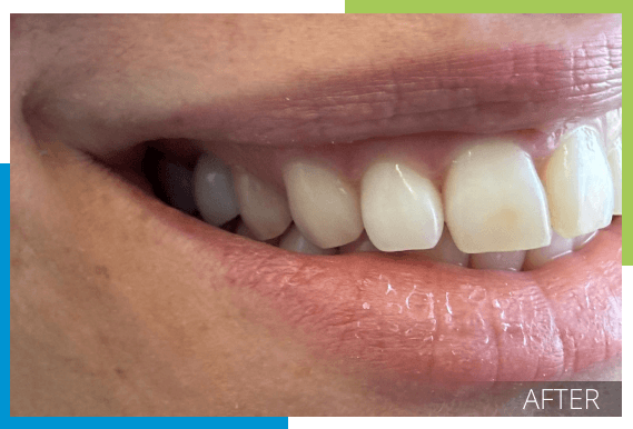 Implant after