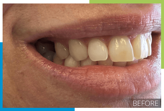 Implant before
