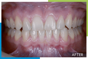 invisalign-1-after