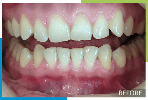 invisalign-1-before