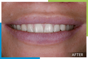 invisalign-2-after