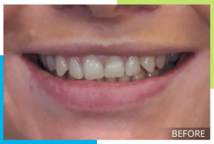 invisalign-2-before