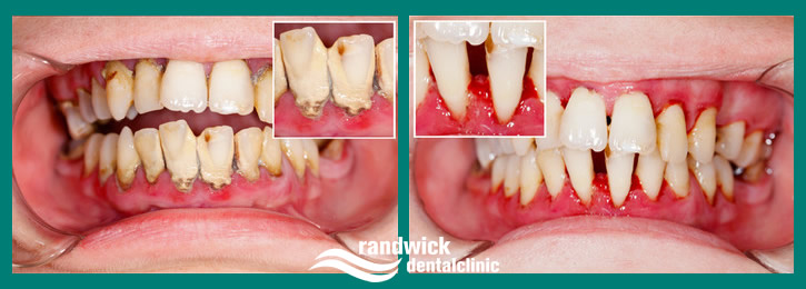 gingivitis before and after treatment