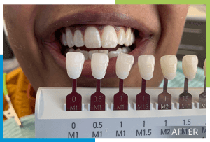 whitening-1-after