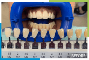 whitening-1-before