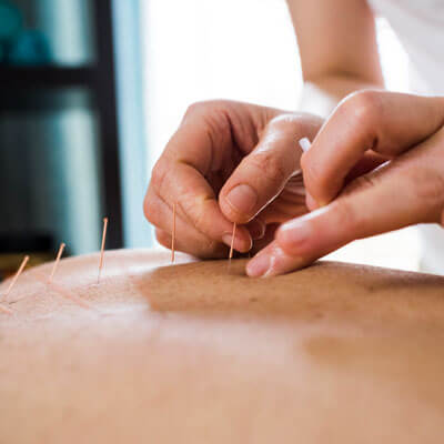 acupuncture needles in persons skin