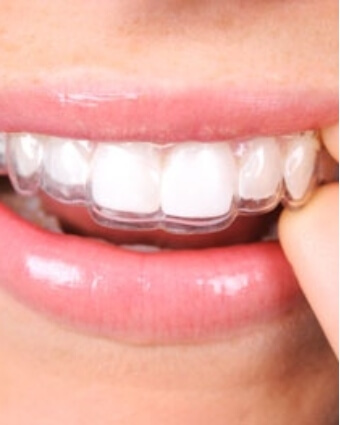 Clear aligners in mouth