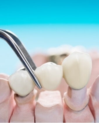 Dental bridge model