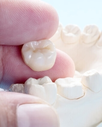 Dental crown model