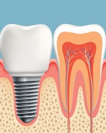 Tooth cross-section illustration