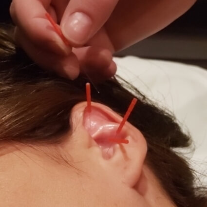 acupuncture in womans ear