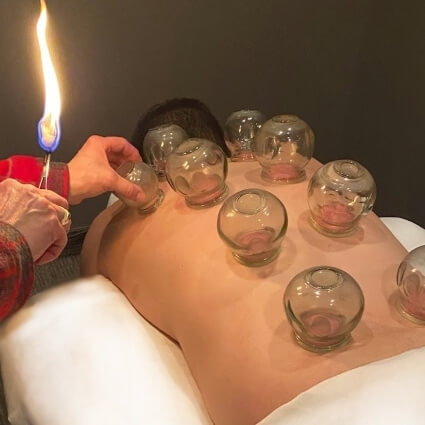 cupping on persons back