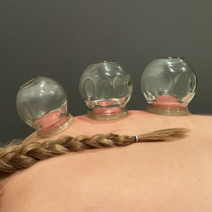 cupping on persons back