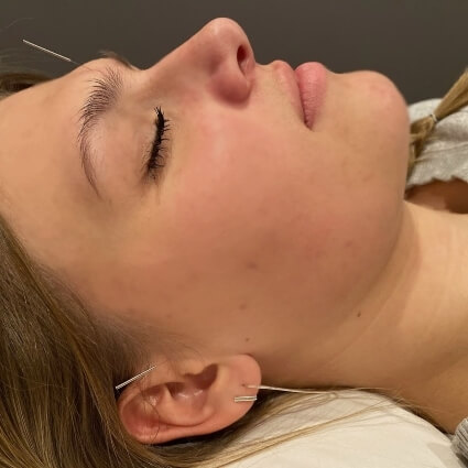 facial acupuncture