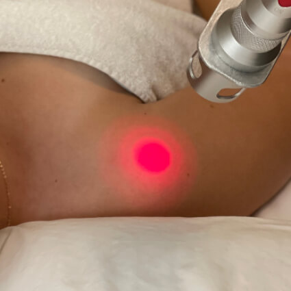 laser treatment on womans shoulder