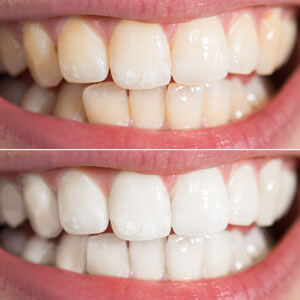 take home teeth whitening