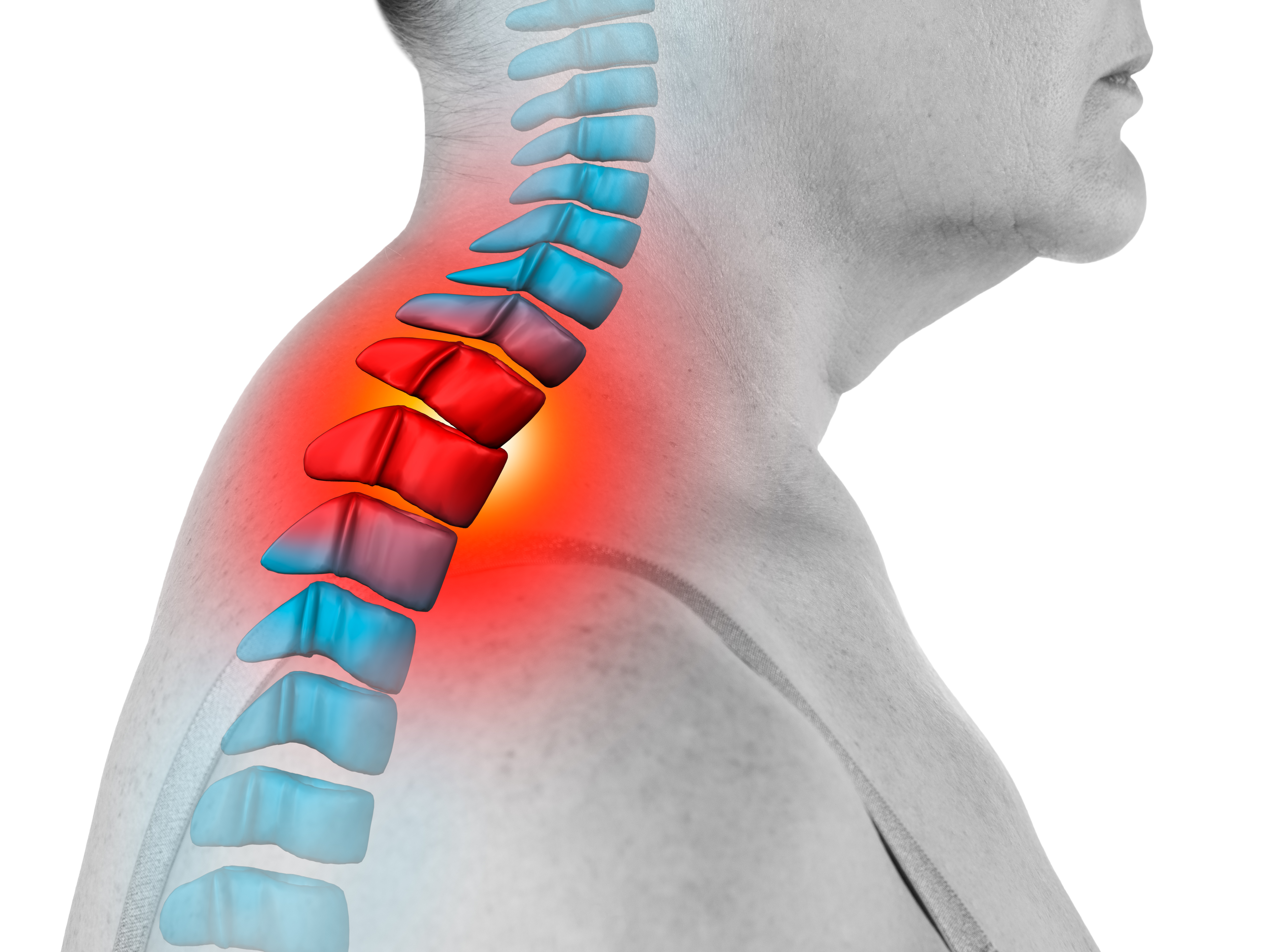Charlestown Chiropractor - Hump at the base of your neck