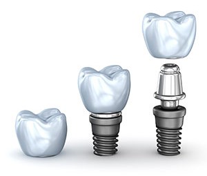 Illustration of dental implant