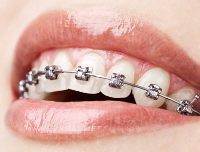woman with traditional wired braces