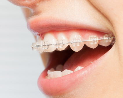 closeup of ceramic braces