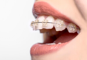 Woman wearing ceramic braces