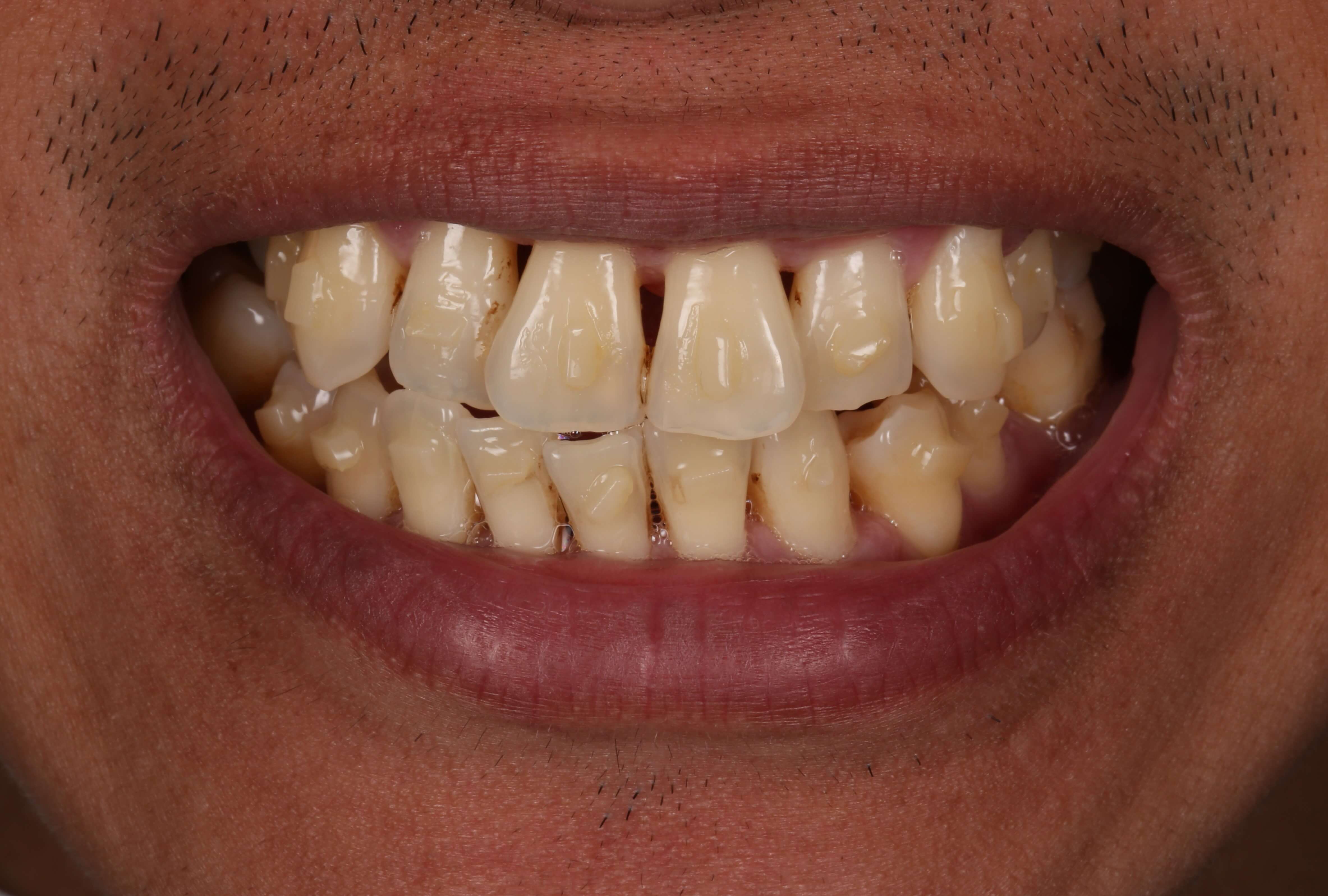 before