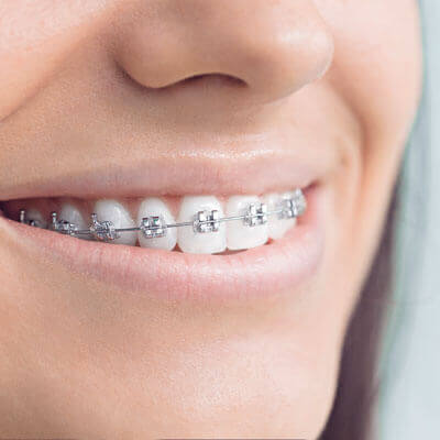 close up of traditional braces