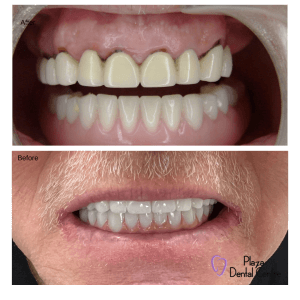 Before &  After Teeth Whitening (1)