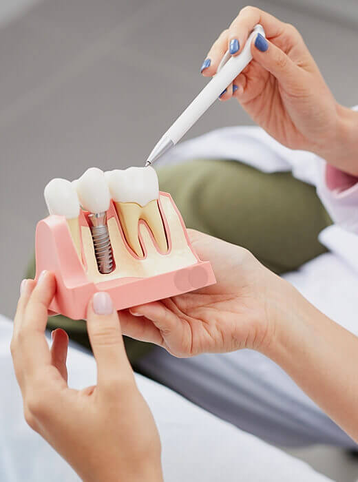model of Dental Implants