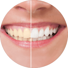 Teeth Whitening before and after