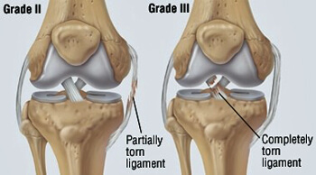 Illustration of knee damage