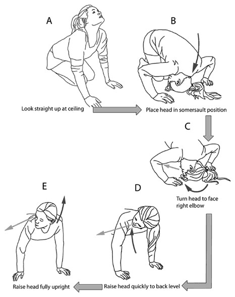 bensign positional vertigo epley maneuver