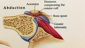 Illustration of shoulder impingement