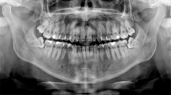 Wisdom Teeth X-ray