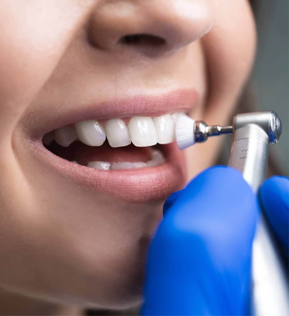 person having teeth cleaned