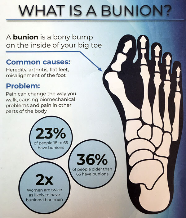What is a Bunion