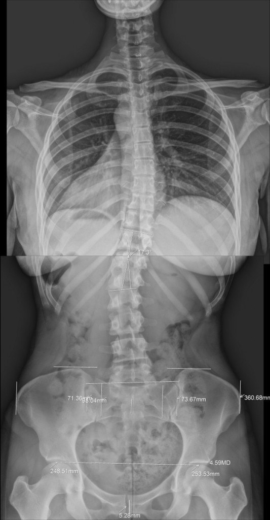 Full-Spine X-ray analysis revealing several areas of misalignment.