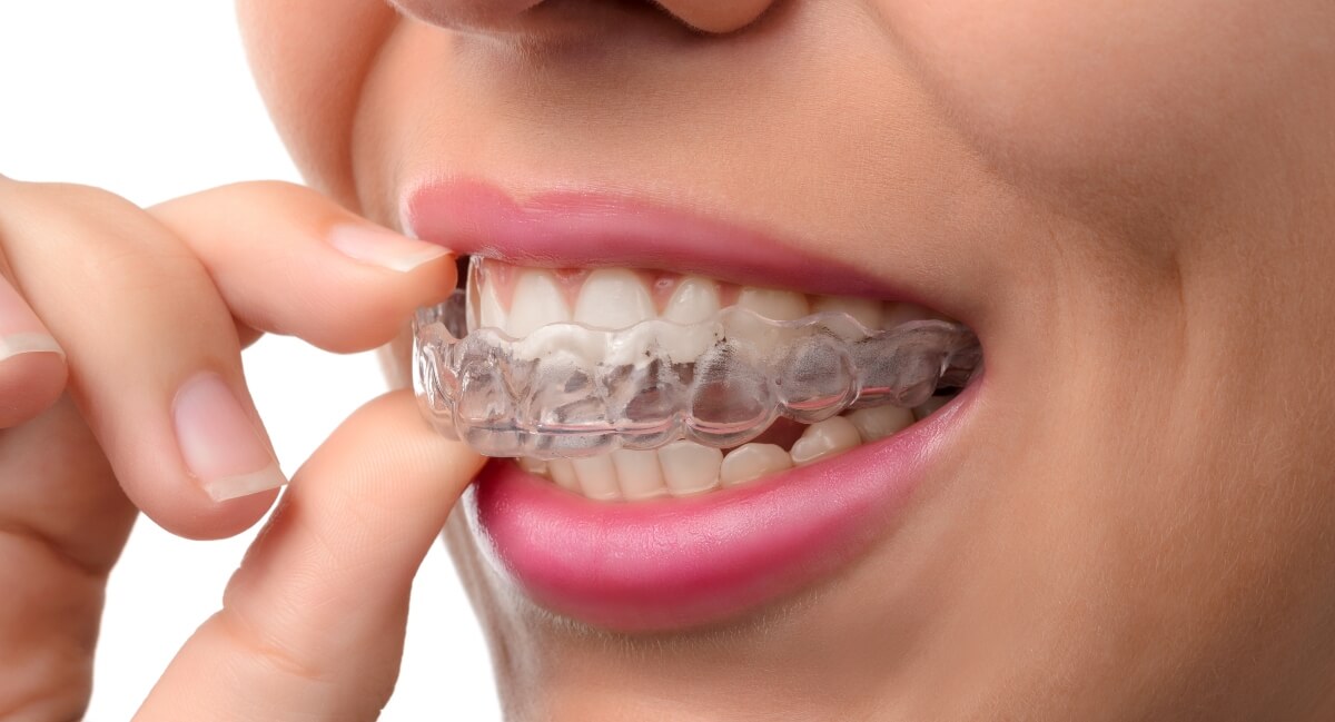 Close-up of woman wearing Invisalign