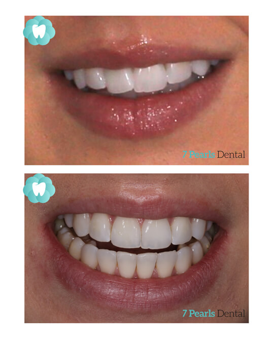 before-after-clear-aligners-1