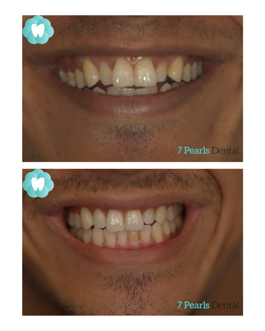 before-after-clear-aligners-2
