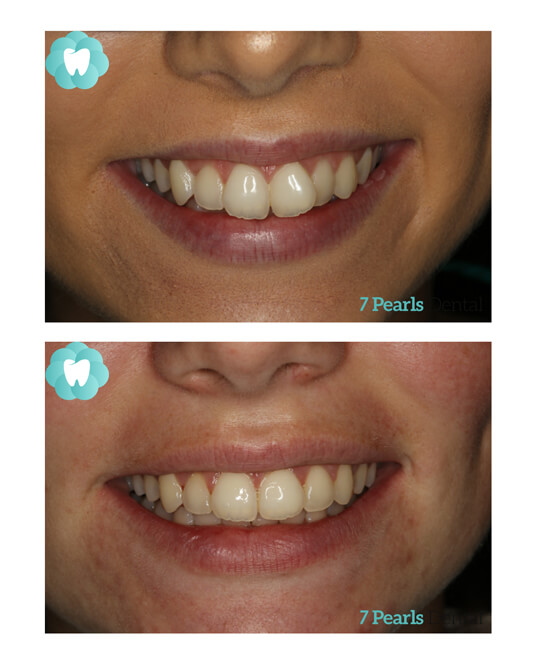 before-after-clear-aligners-3