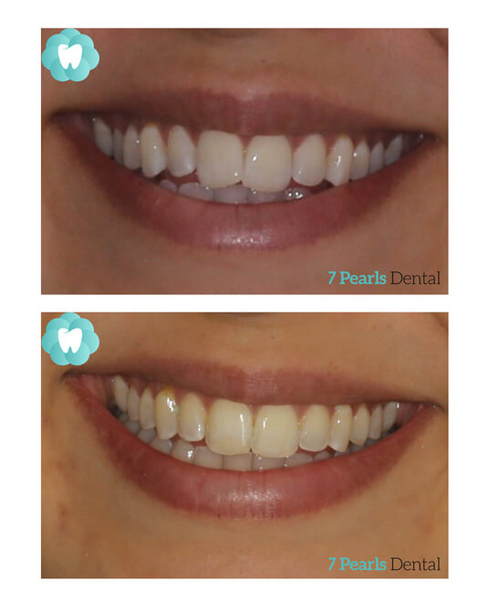 before-after-clear-aligners-4
