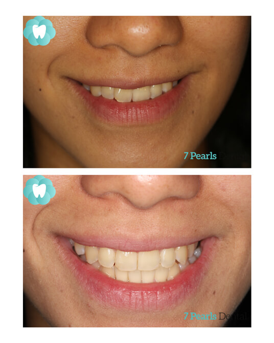 before-after-clear-aligners-5