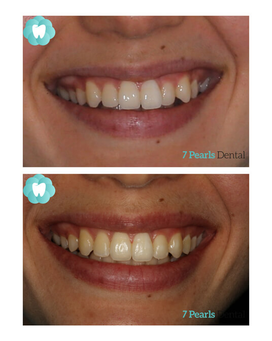 before-after-clear-aligners-6