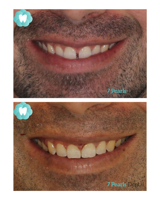 before-after-clear-aligners-7
